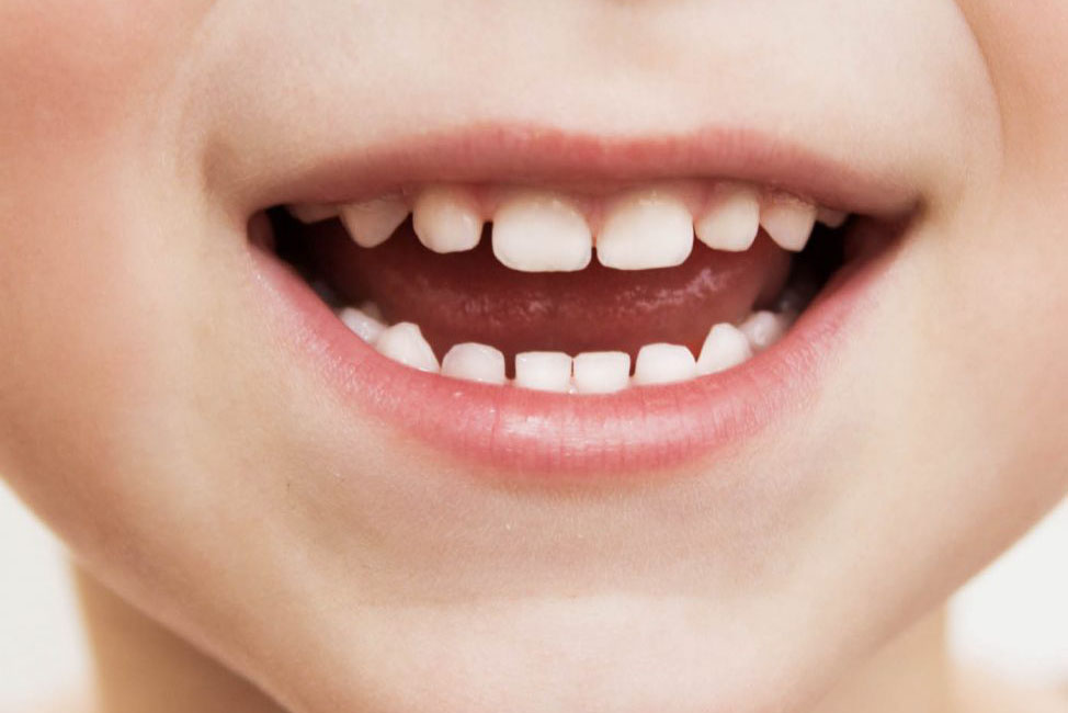 răng sữa vẫn có nguy cơ sâu răng và gây biến chứng khó lường