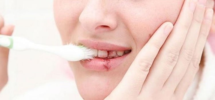 Bị chảy máu khi đánh răng - dấu hiệu của bệnh viêm nướu