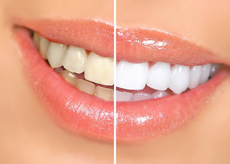 Sự khác biệt giữa 2 hoạt chất tẩy trắng răng phổ biến nhất hiện nay