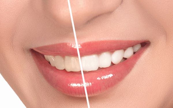 Tẩy trắng răng có hại không? Những kiến thức cơ bản về tẩy trắng