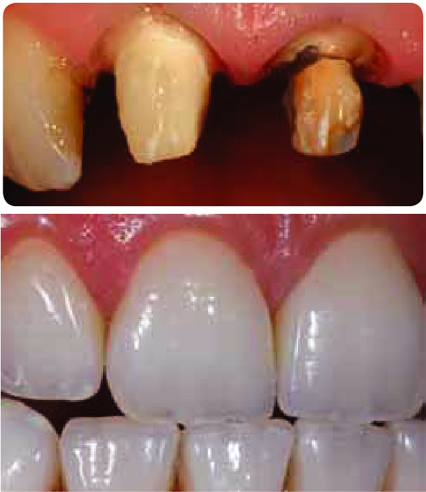 vật liệu sứ emax - phục hình bền chắc và thẩm mỹ như răng thật