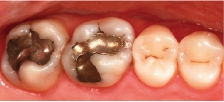 Hình 12: Hai răng thiếu hạt độn amalgam phải được thay thế