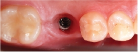 Hình 31: Sau quy trình nhổ răng và cấy ghép, khu vực đó đã sẵn sàng gắn phục hình mới.