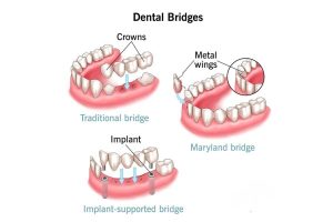 Sơ đồ minh họa các loại cầu răng phổ biến: truyền thống, cánh dán Maryland và cầu răng trên implant.
