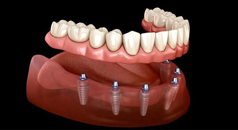 Hàm nhựa trên implant (implant-supported overdenture) sử dụng hệ thống attachment để tăng độ lưu giữ và ổn định phục hình.