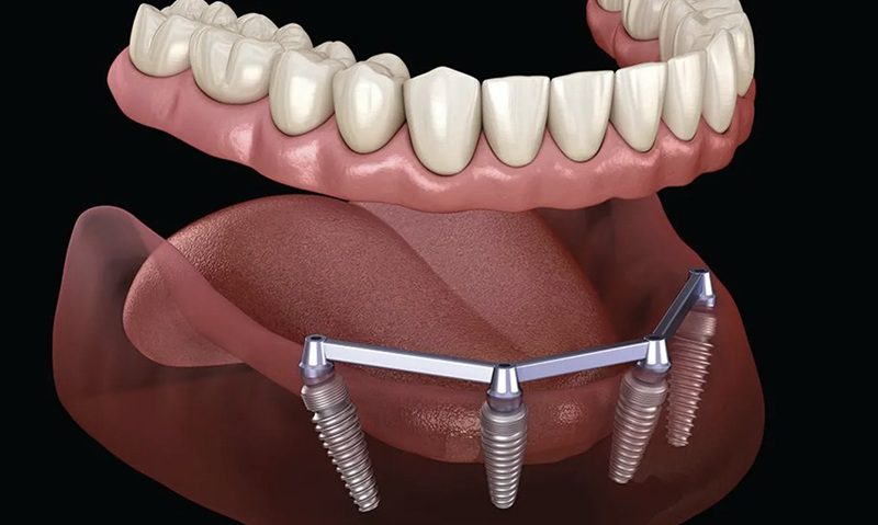 Hàm nhựa trên implant cải thiện độ ổn định nhờ điểm tựa bổ sung từ hệ thống attachment trên implant.