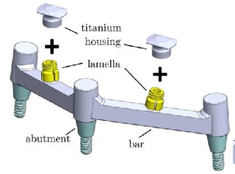 Ball attachment, bar-clip và telescopic là ba hệ thống lưu giữ phổ biến cho hàm nhựa trên implant, mỗi loại phù hợp với số lượng implant và nhu cầu lâm sàng khác nhau.