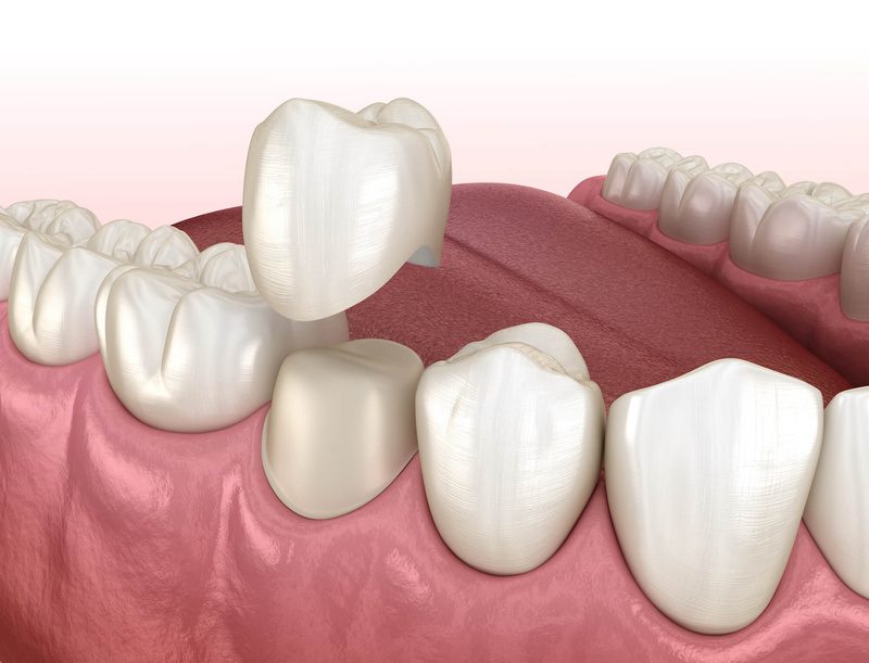 Răng tạm bảo vệ cùi răng và duy trì thẩm mỹ, chức năng ăn nhai trong thời gian chờ phục hình vĩnh viễn hoàn thiện.